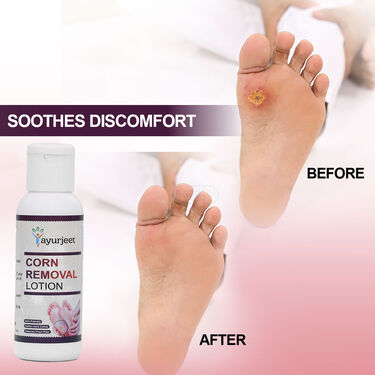Pain Free Corn Removal Lotion (FCRL)