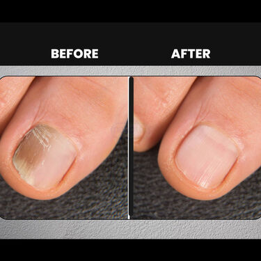 Nail Fungus & Infection Repair Oil