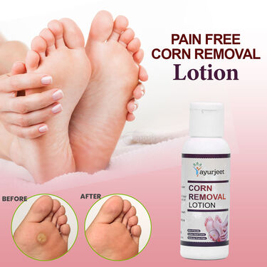 Pain Free Corn Removal Lotion (FCRL)