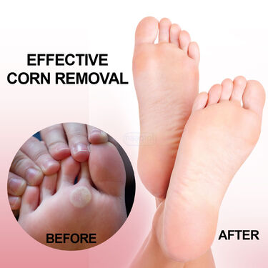 Pain Free Corn Removal Lotion (FCRL)