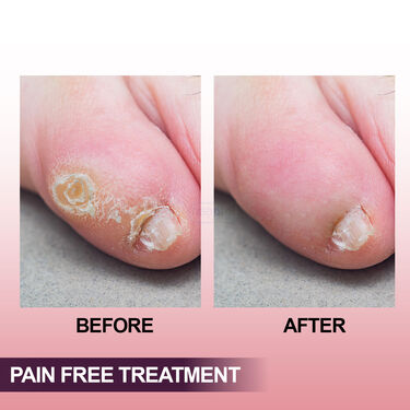 Pain Free Corn Removal Lotion (FCRL)