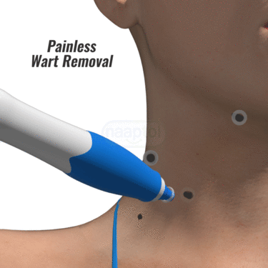 Painless Massa Remover Kit (WR2)